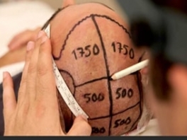 FUE Hair Transplantation Process